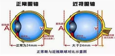 近視眼球突出？！控制近視度數(shù)加深是關(guān)鍵！