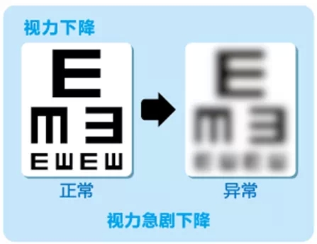 視網(wǎng)膜脫離啥癥狀？這張圖告訴你！