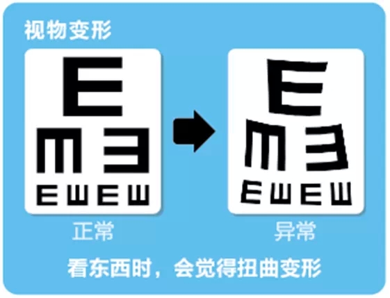 視網(wǎng)膜脫離啥癥狀？這張圖告訴你！