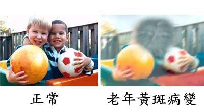 黃斑變性與老花眼，兩者不一樣！