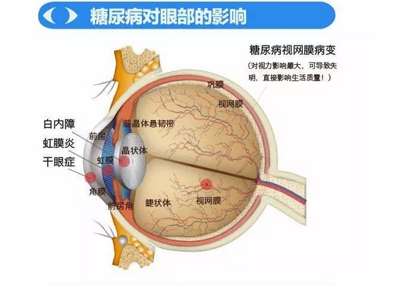 你造嗎？糖尿病晚期眼睛會(huì)致盲！