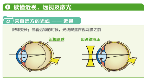 【看圖解】一張圖教你看懂近視、遠(yuǎn)視和散光