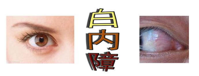 白內(nèi)障手術(shù)會(huì)反復(fù)嗎？