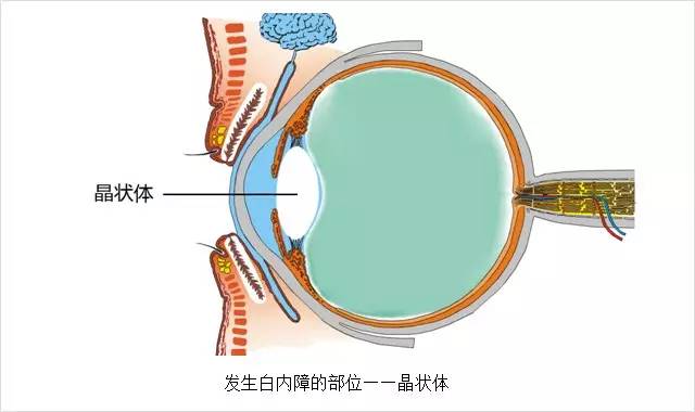 眼科主任告誡白內(nèi)障這幾大誤區(qū)，80%的老人上當(dāng)