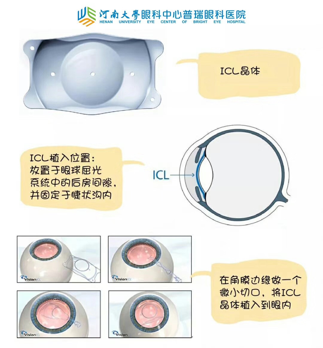 近視度數(shù)太高，還能做手術嗎？