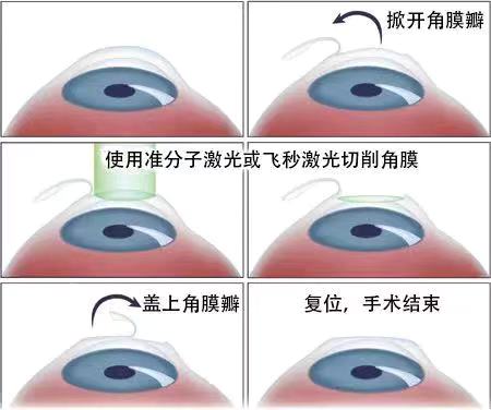 如果眼睛近視了該怎么？